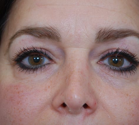 Blepharoplasty Before, Female 46 - 22