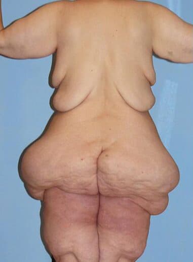 Body Contouring Solutions Before, Female 50 - 2574