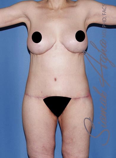 Body Contouring Solutions After, Female 50 - 2575