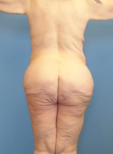 Body Contouring Solutions Before, Female 50 - 2571