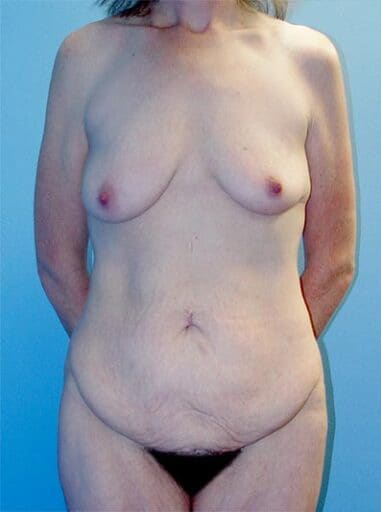 Body Contouring Solutions Before, Female 41 - 2559