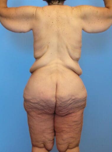 Body Contouring Solutions Before, Female 46 - 2565