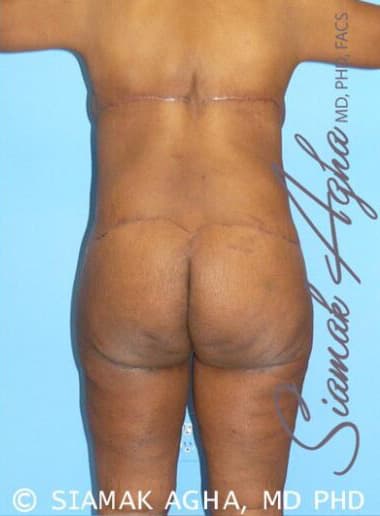 Body Contouring Solutions After, Female 54 - 2567