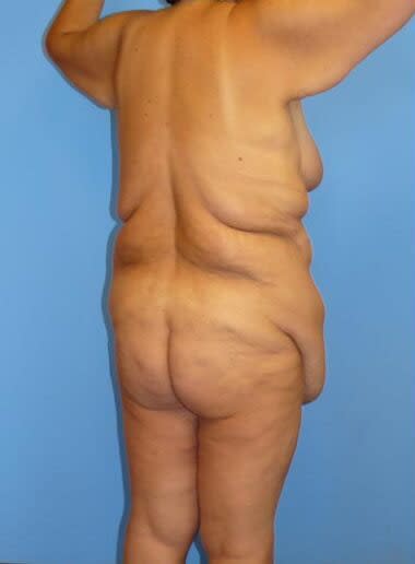 Body Contouring Solutions Before, Female 38 - 2569