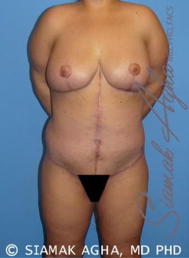 Body Contouring Solutions After, Female 38 - 2570