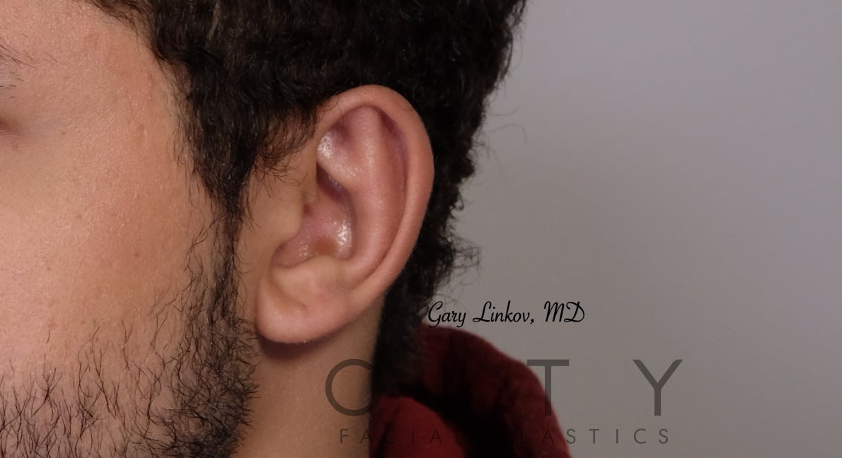 Otoplasty After, Male 30 - 366