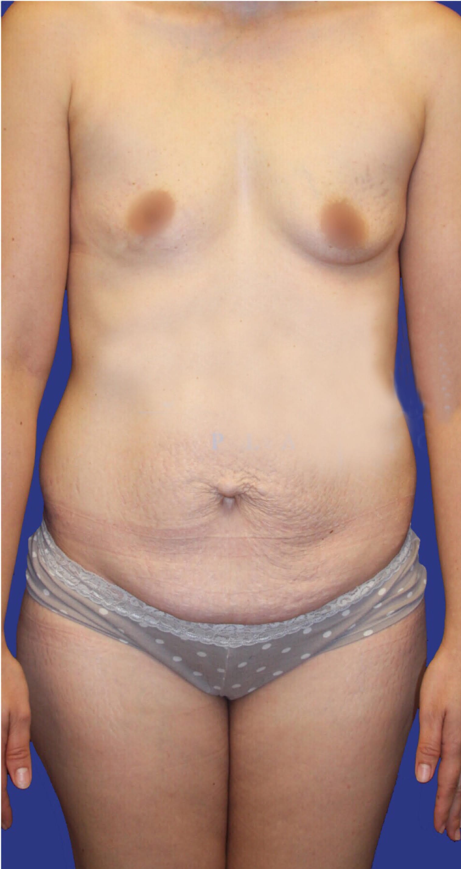 Tummy Tuck (Abdominoplasty) Before, Female 40 - 117