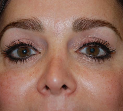 Blepharoplasty After, Female 46 - 22