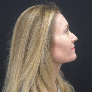 Laser Skin Resurfacing After, Female 51 - 3986