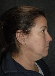 Facelift Before, Female 52 - 4606