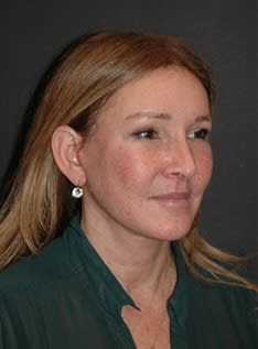 Facelift After, Female 55 - 4601