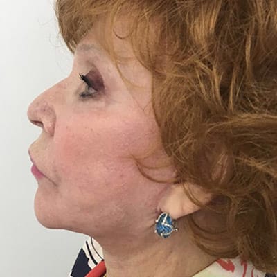 Facelift After, Female 65 - 4209