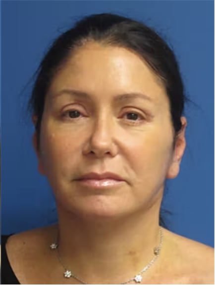 Brow Lift After, Female 41 - 3021