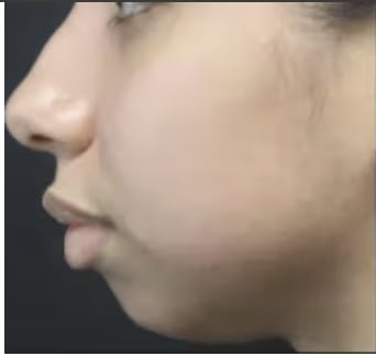 Chin Augmentation Before, Female 23 - 3033
