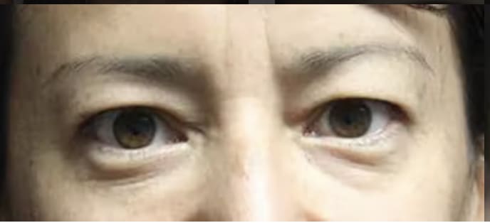 Blepharoplasty Before, Female 42 - 3030