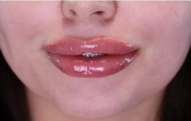 Lip Augmentation and Injections After, Female 28 - 3601