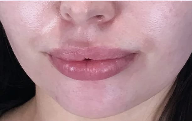 Lip Augmentation and Injections Before, Female 28 - 3601