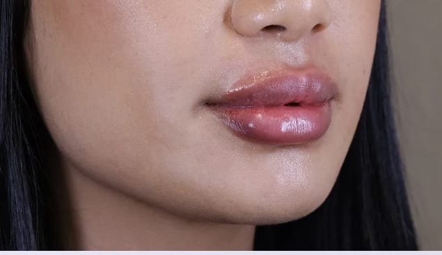 Lip Augmentation and Injections After, Female 25 - 3602