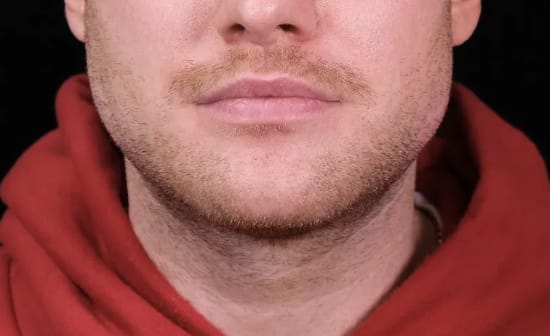 Dermal Fillers & Injectables After, Male 29 - 3604