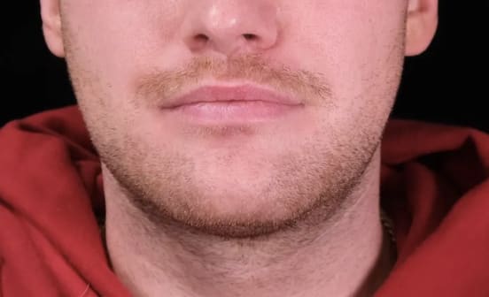 Dermal Fillers & Injectables Before, Male 29 - 3604