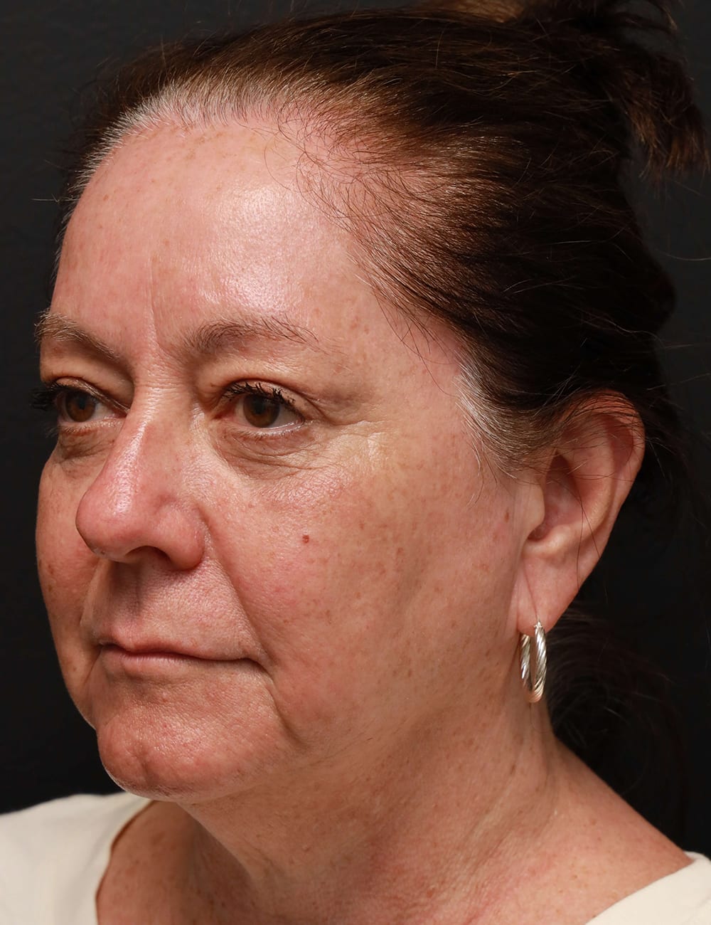 Blepharoplasty After, Female 56 - 1628