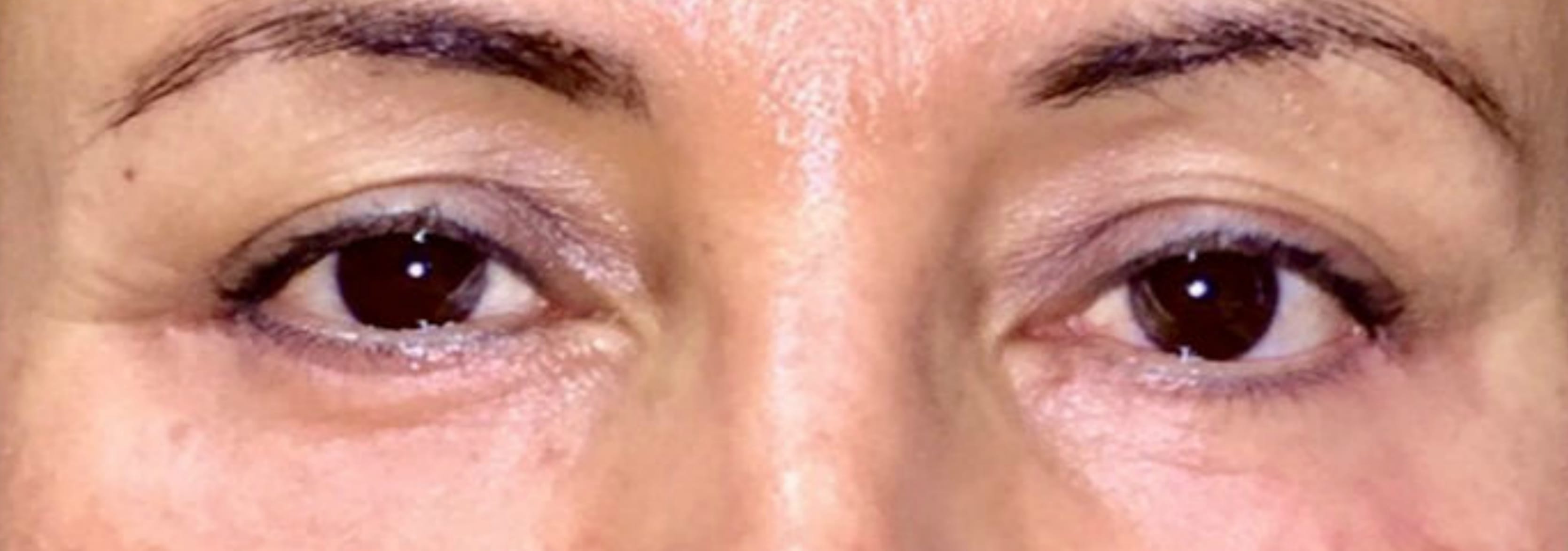 Blepharoplasty After, Female 40 - 113