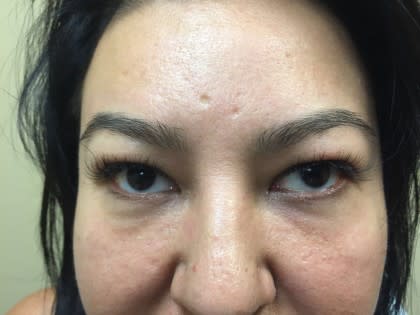 Facelift Before, Female 60 - 4207