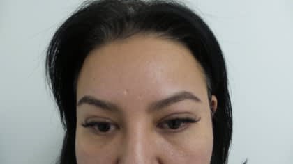 Facelift After, Female 60 - 4207