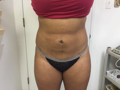 Brazilian Butt Lift After, Female 40 - 4199