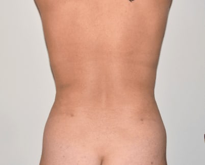 Radiofrequency-Assisted Liposuction (RFAL) After, Female 45 - 198