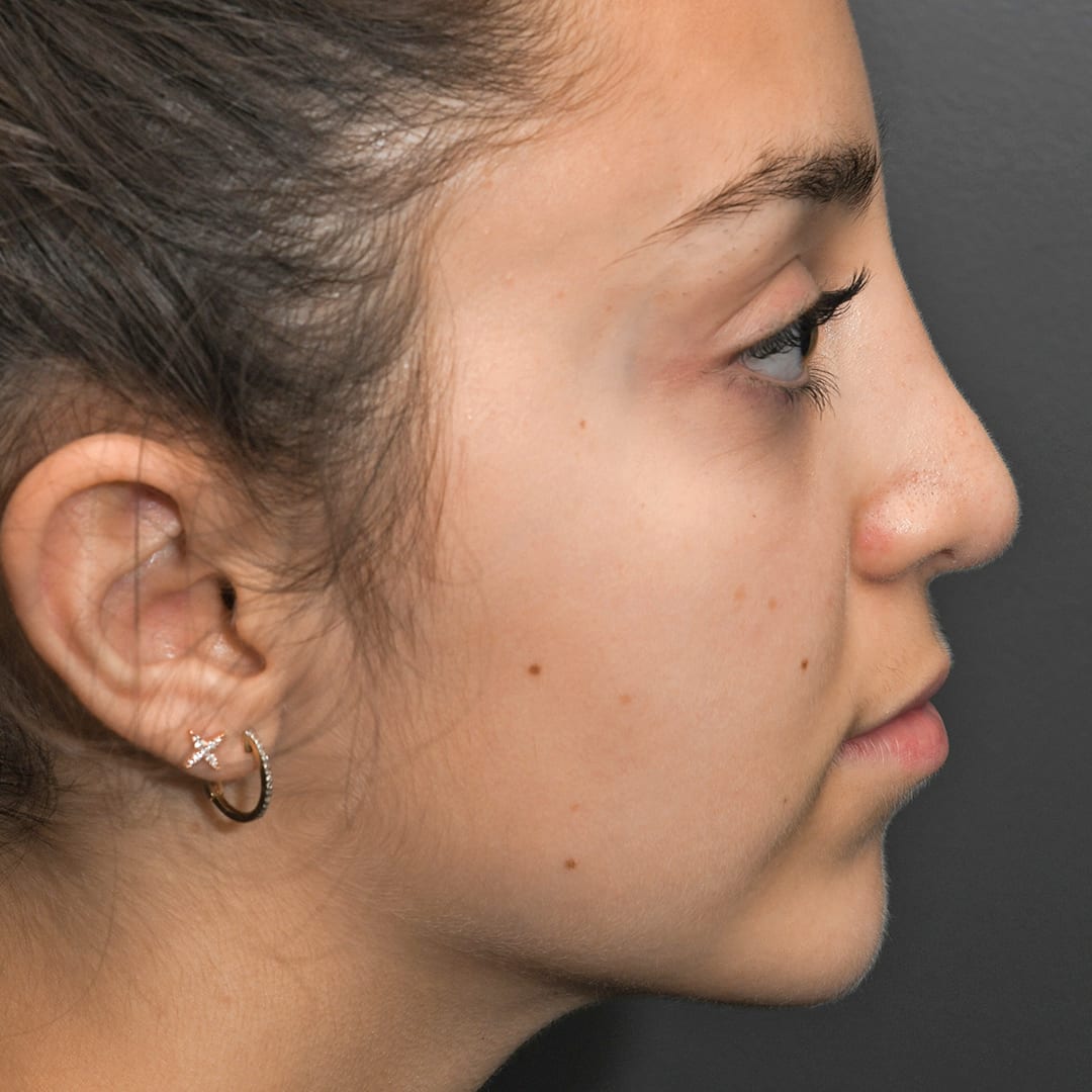 Chin Augmentation After, Female 15 - 36