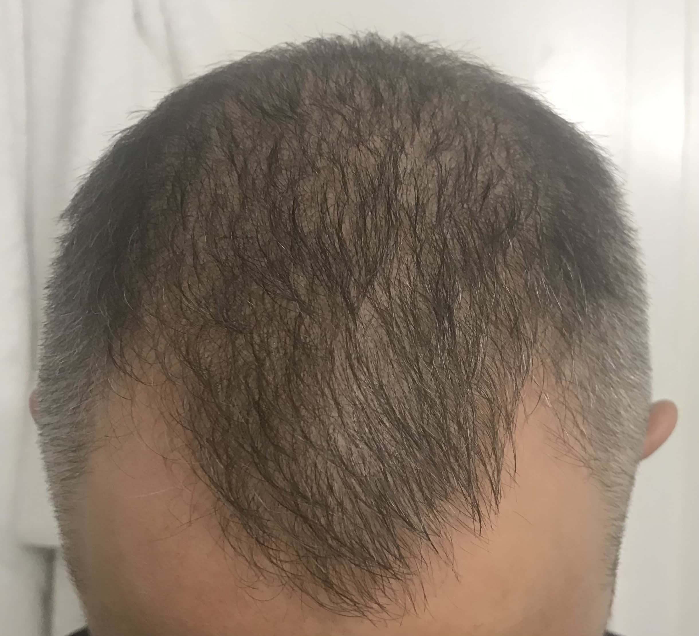 Platelet-Rich Plasma (PRP) Injections for Hair Loss After, Male 56 - 920