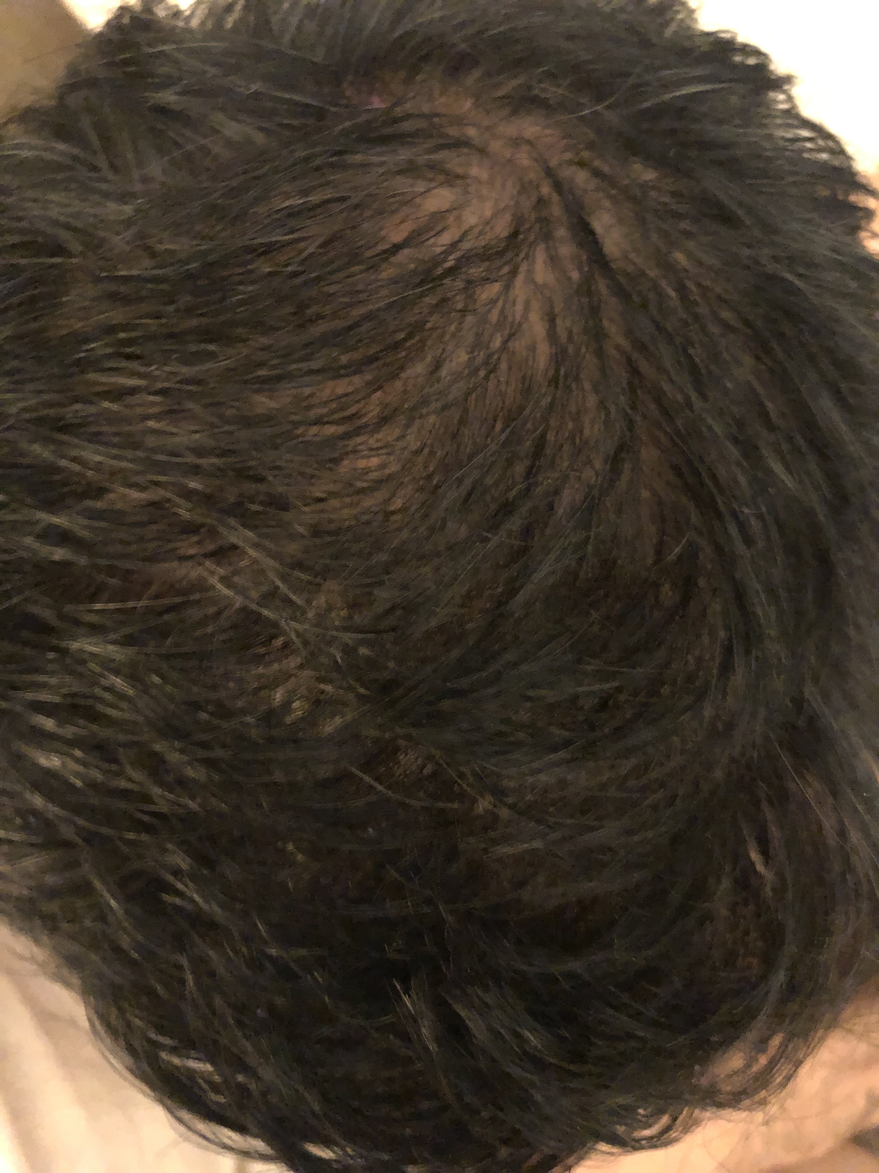 Platelet-Rich Plasma (PRP) Injections for Hair Loss After, Male 34 - 921