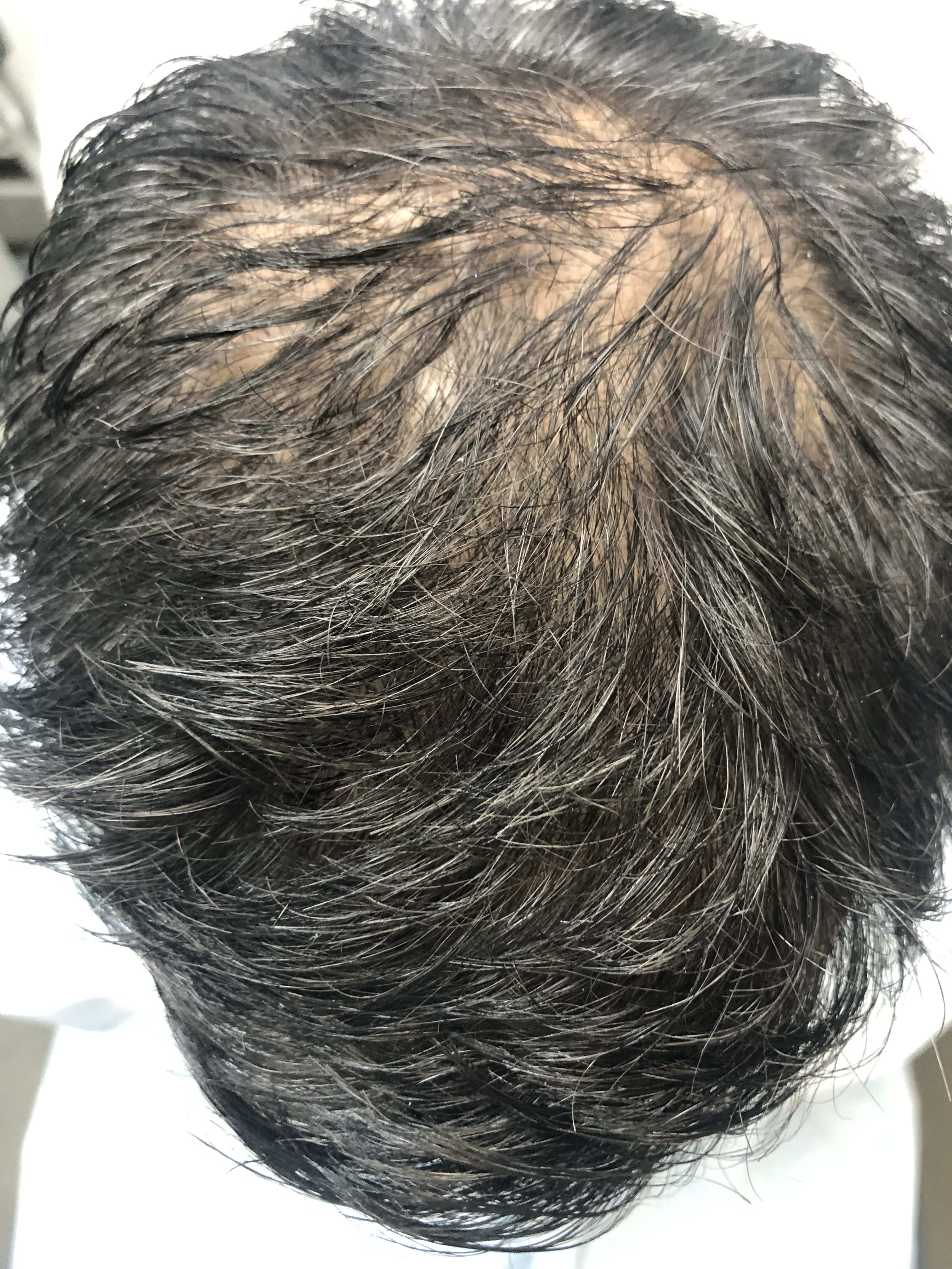 Platelet-Rich Plasma (PRP) Injections for Hair Loss Before, Male 34 - 921