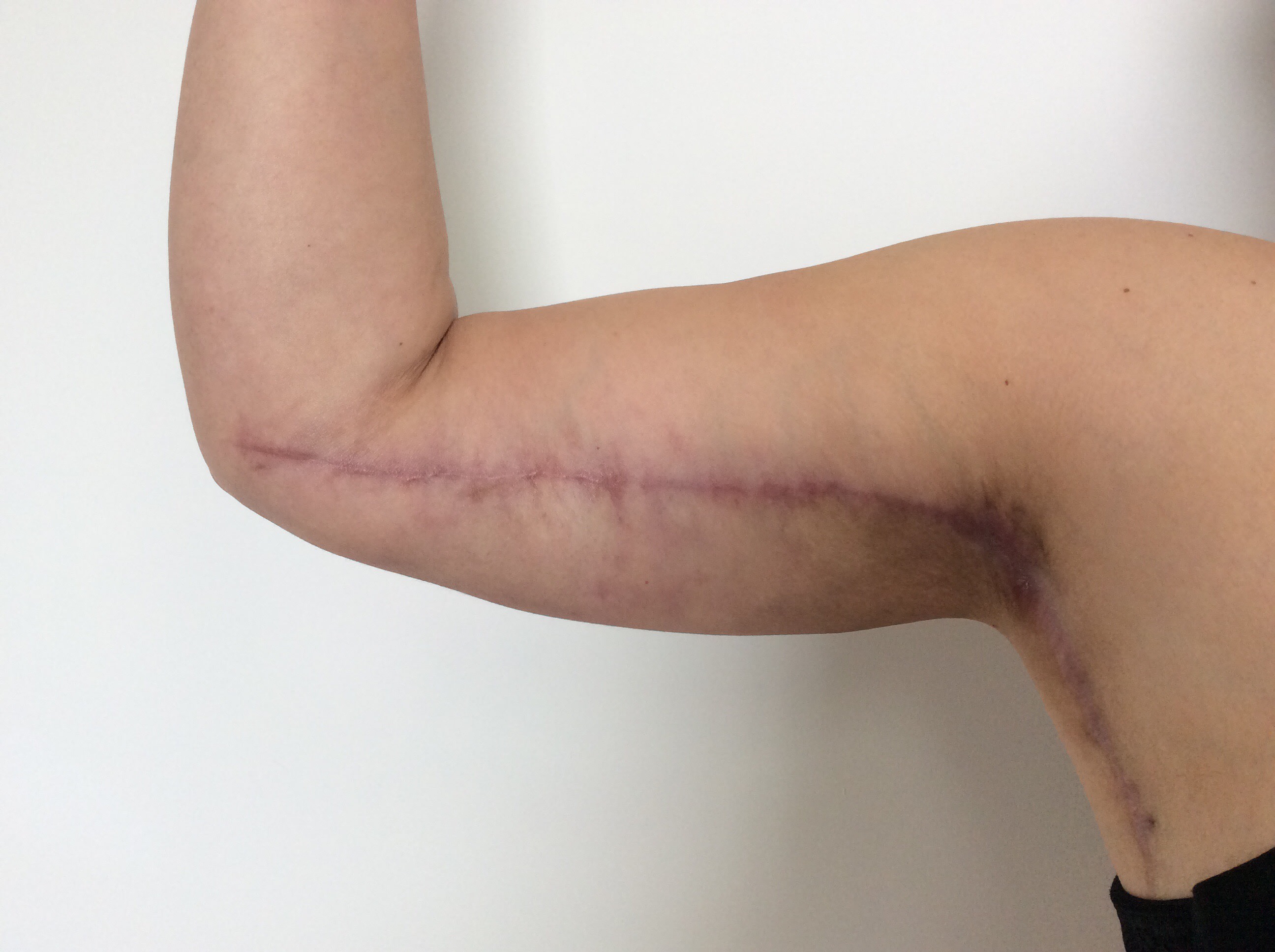 Arm Lift (Brachioplasty) After, Female 46 - 2042