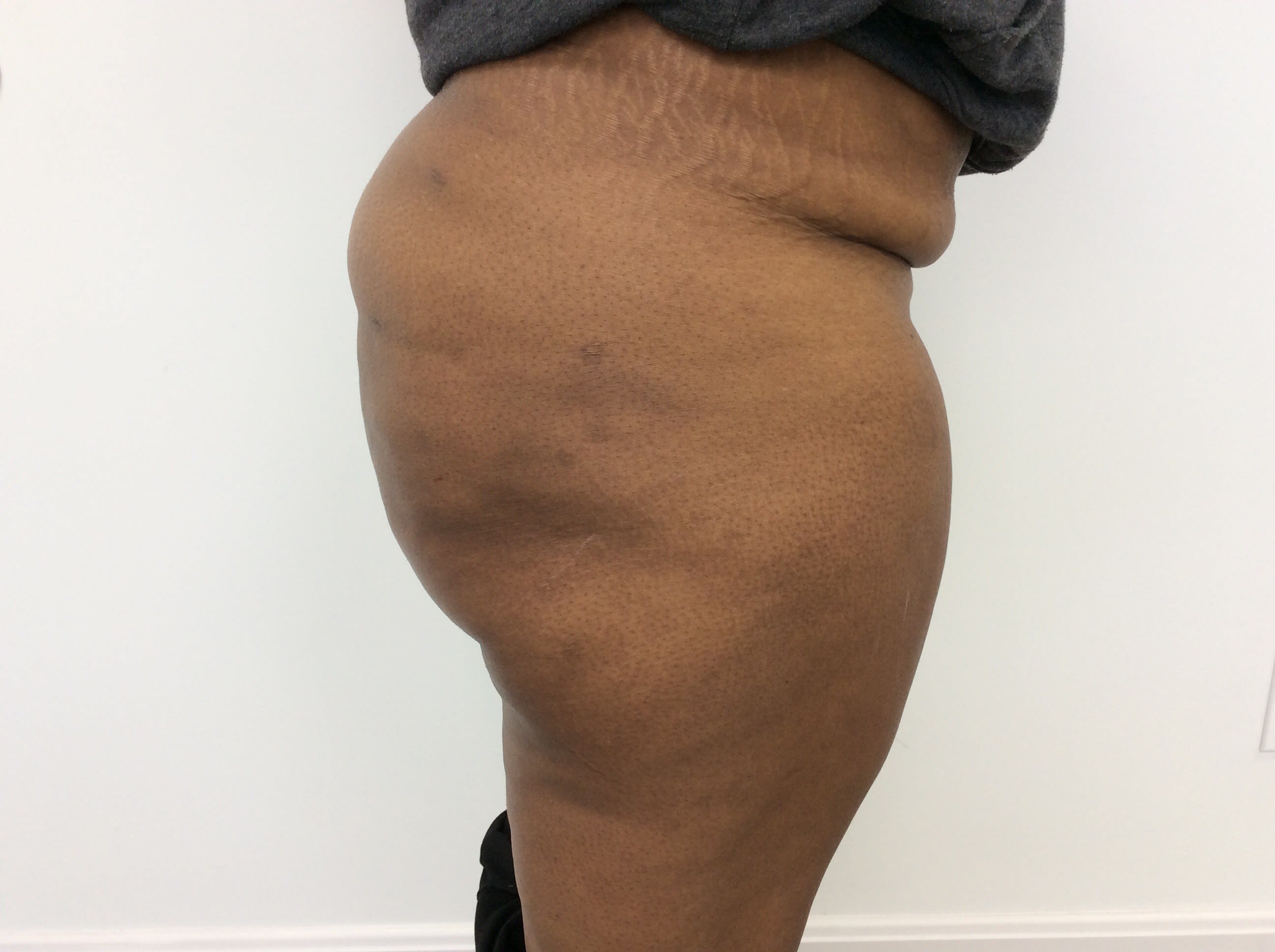 Brazilian Butt Lift After, Female 43 - 2050