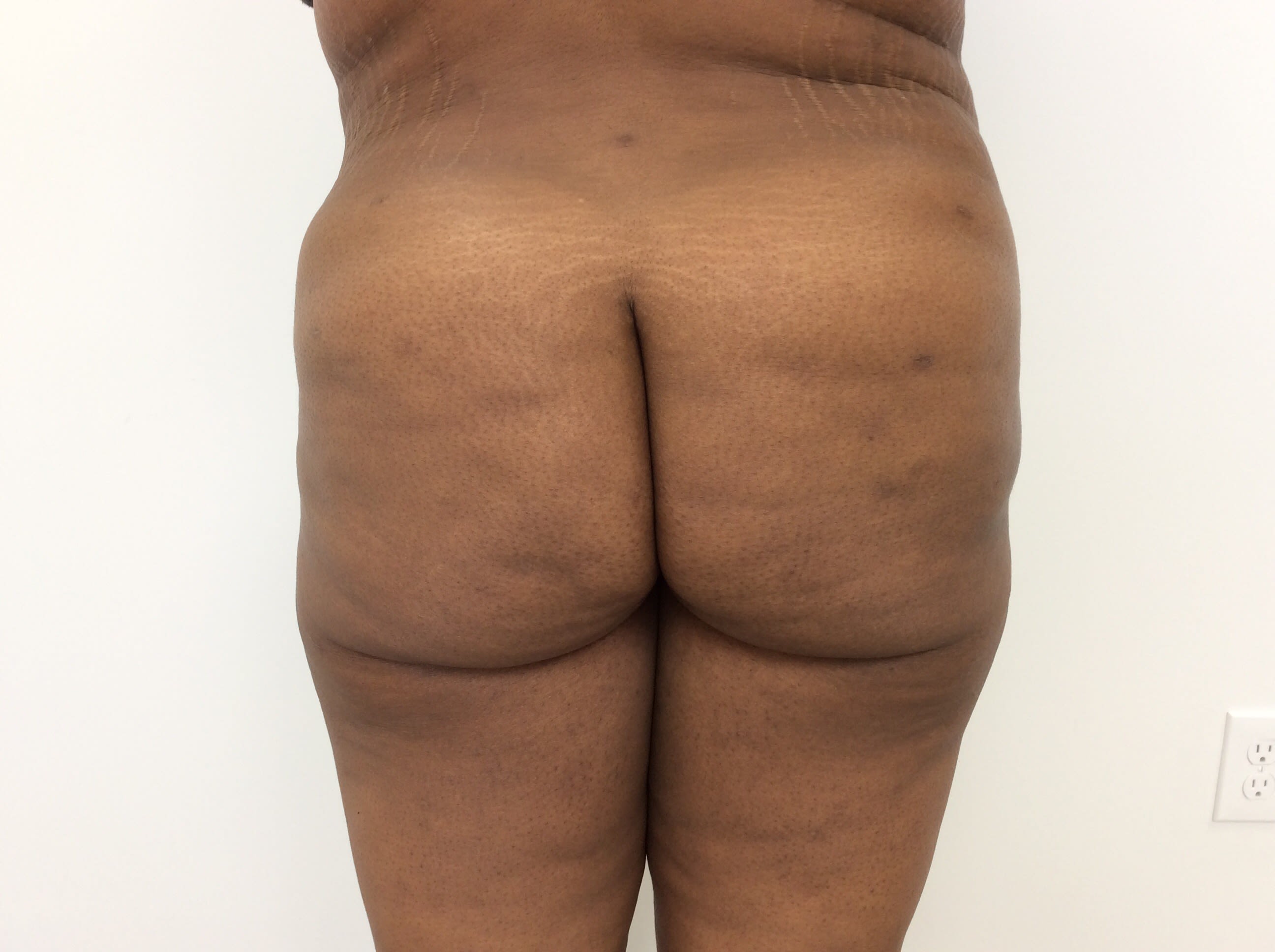 Brazilian Butt Lift After, Female 43 - 2049
