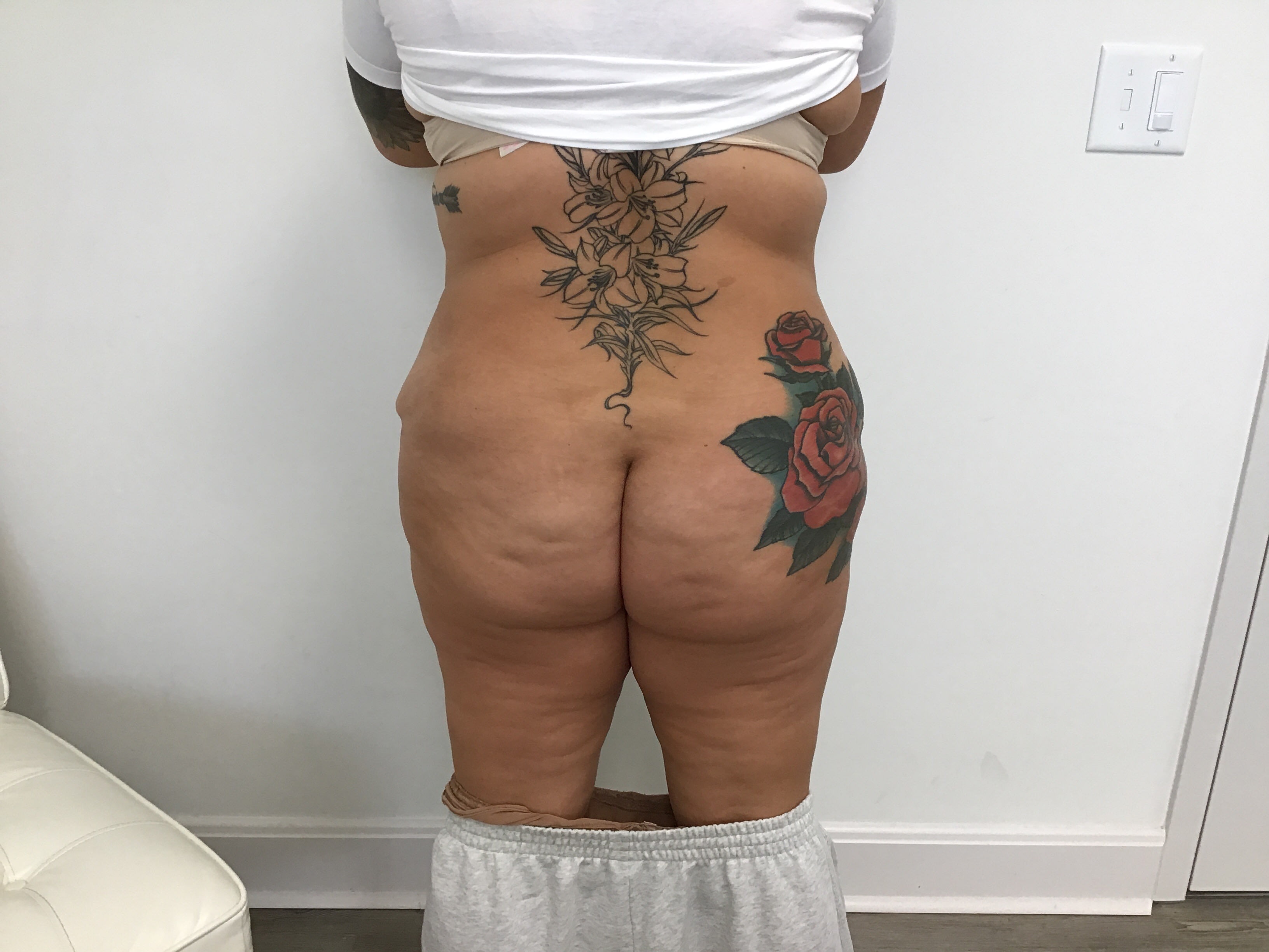 Brazilian Butt Lift Before, Female 39 - 2055
