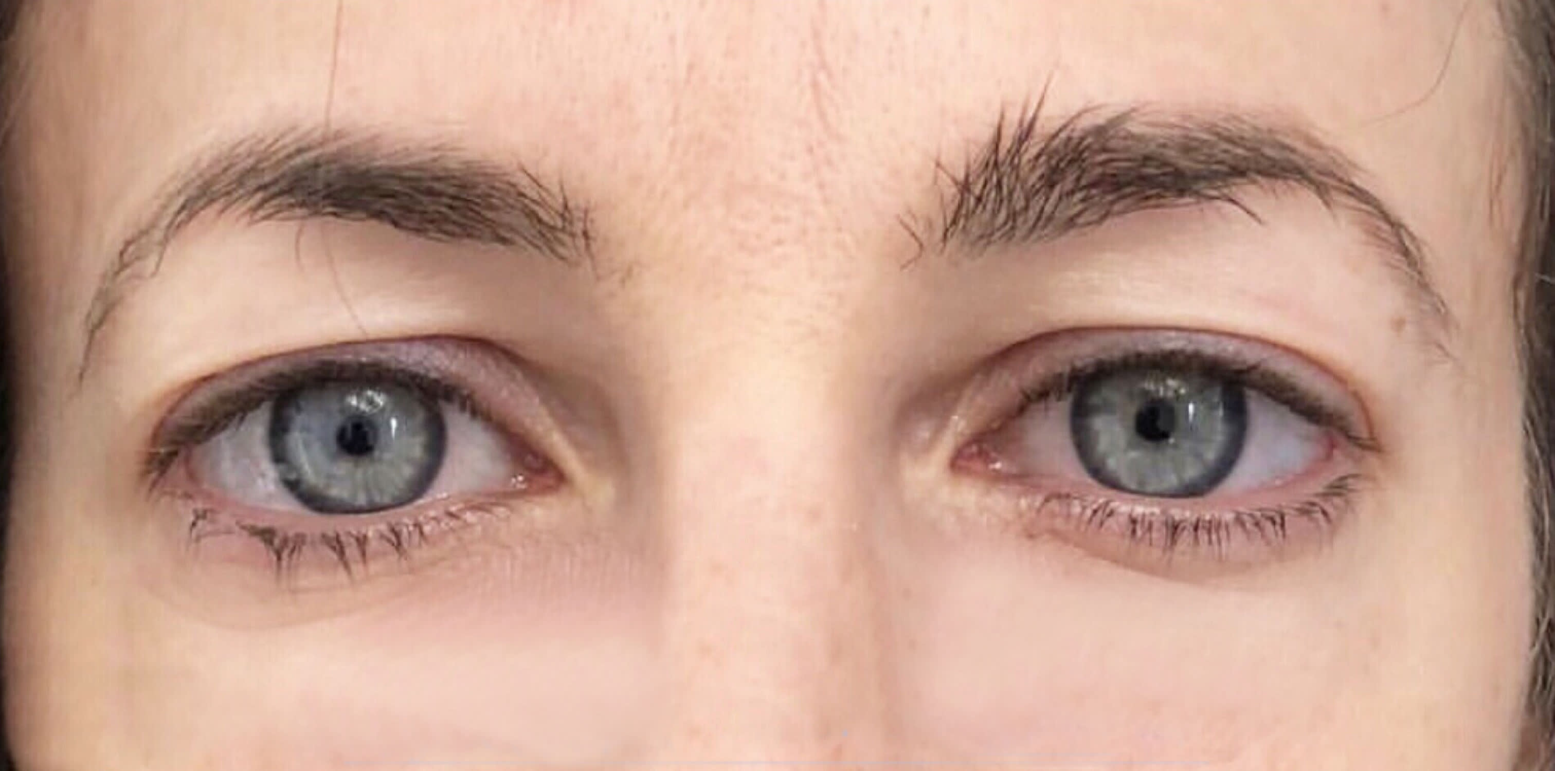 Blepharoplasty Before, Female 40 - 109