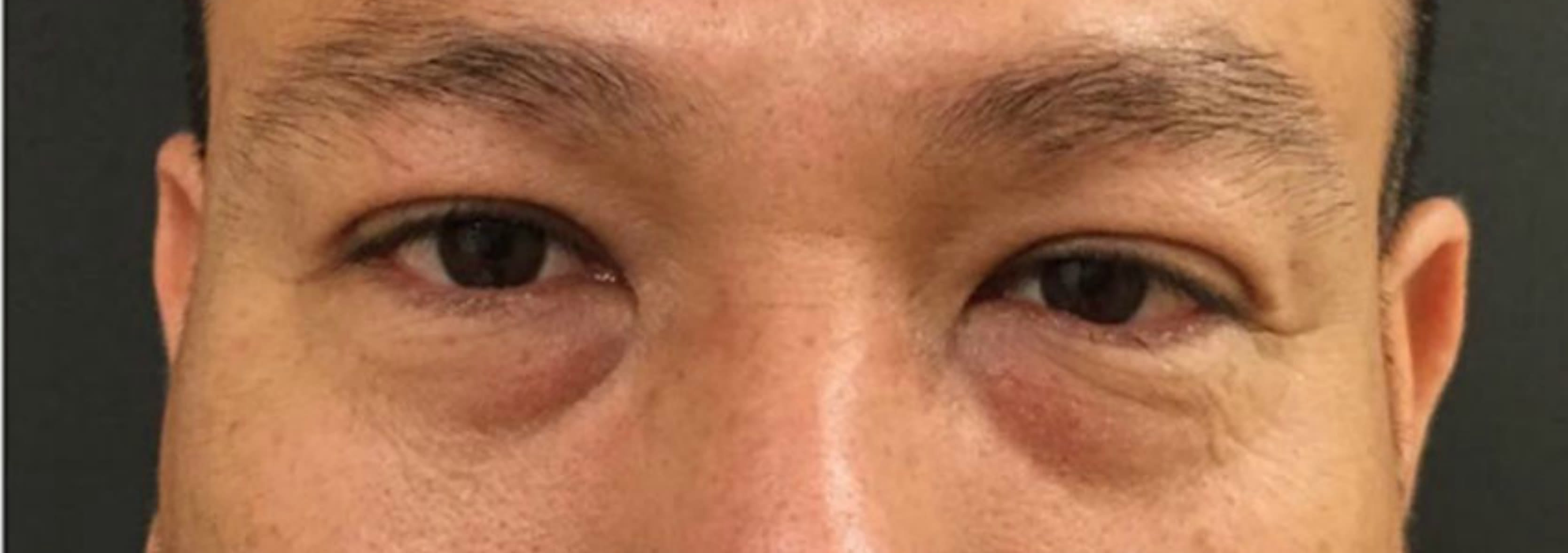 Blepharoplasty Before, Male 35 - 115