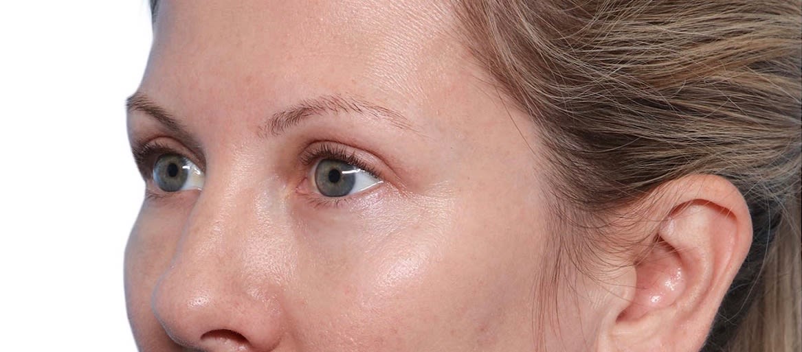 Blepharoplasty After, Female 50 - 2322