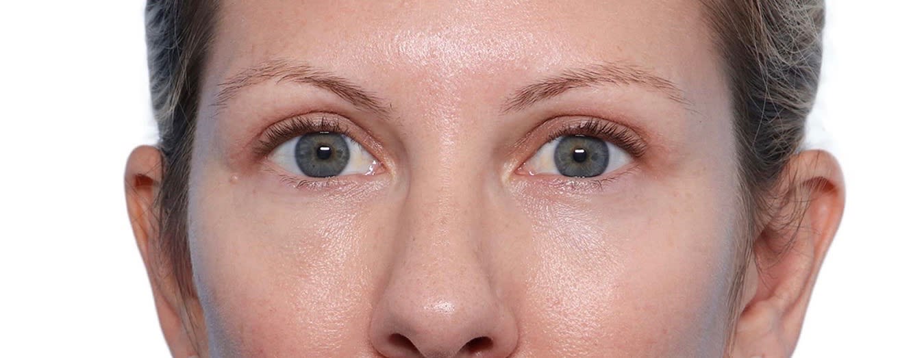 Blepharoplasty After, Female 50 - 2305