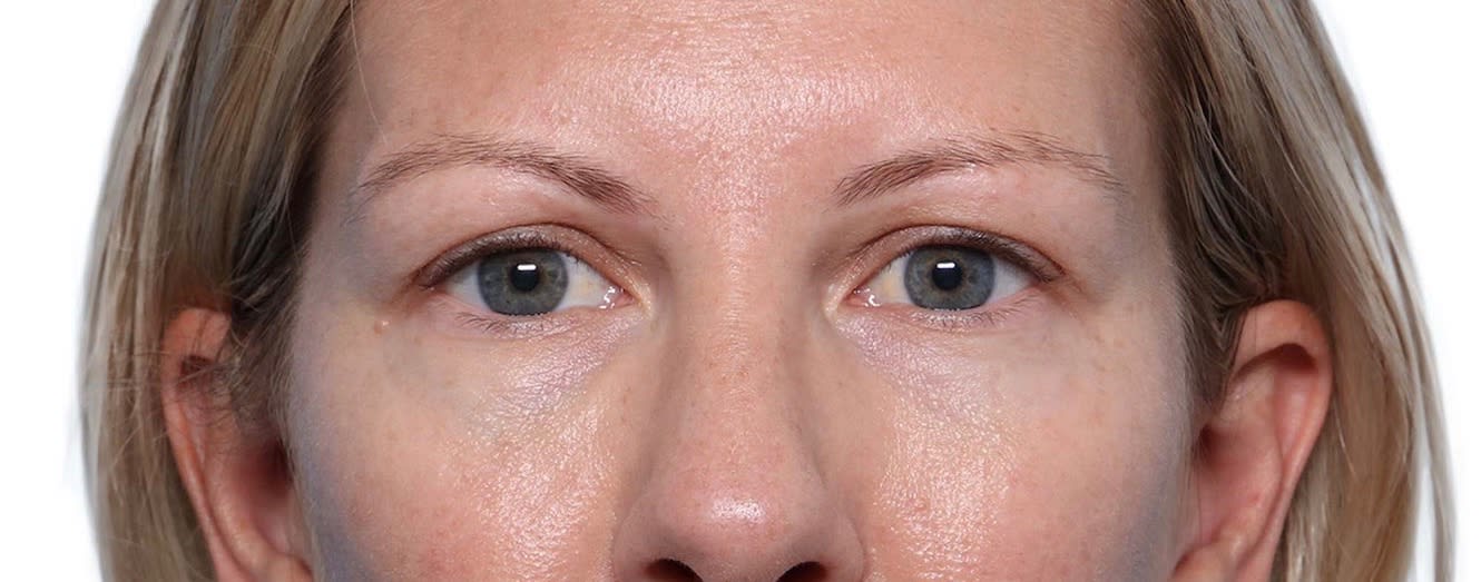 Blepharoplasty Before, Female 50 - 2305