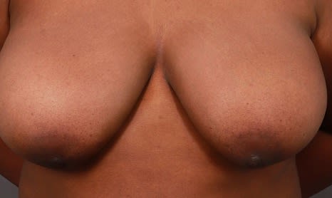 Breast Reduction (Reduction Mammaplasty) Before, Female 40 - 4581