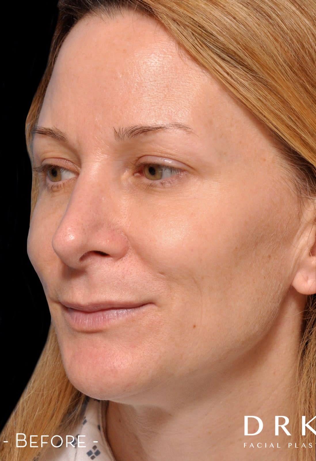 Closed Rhinoplasty Before, Female 50 - 3156