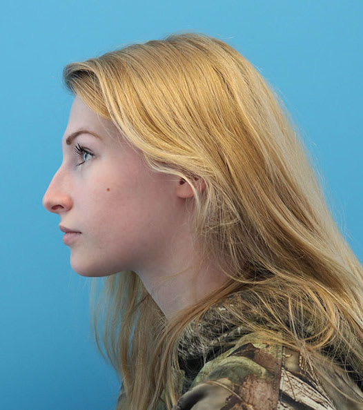 Rhinoplasty Before, Female 23 - 2352