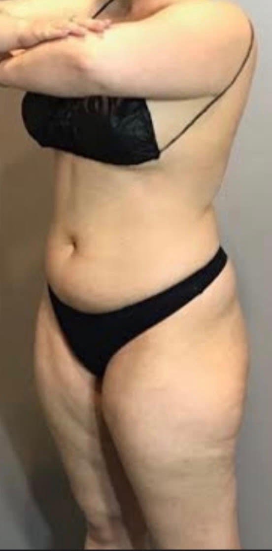 Brazilian Butt Lift Before, Female 38 - 2245