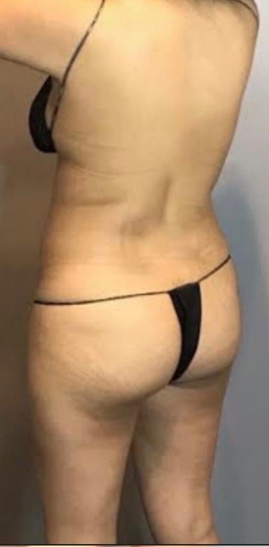 Brazilian Butt Lift Before, Female 38 - 2244