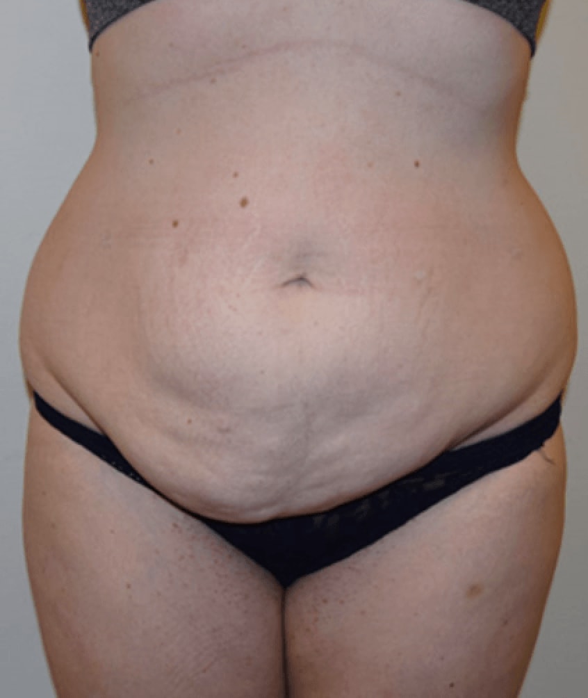 Abdominoplasty Before, Female 30 - 199