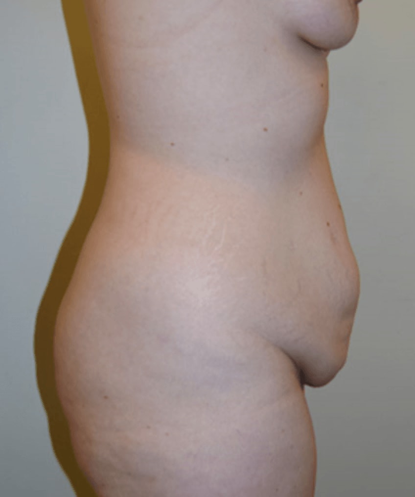 Abdominoplasty Before, Female 30 - 200